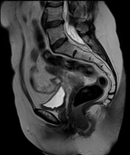 File:Cervical carcinoma (Radiopaedia 88312-104943 Sagittal T2 15).jpg