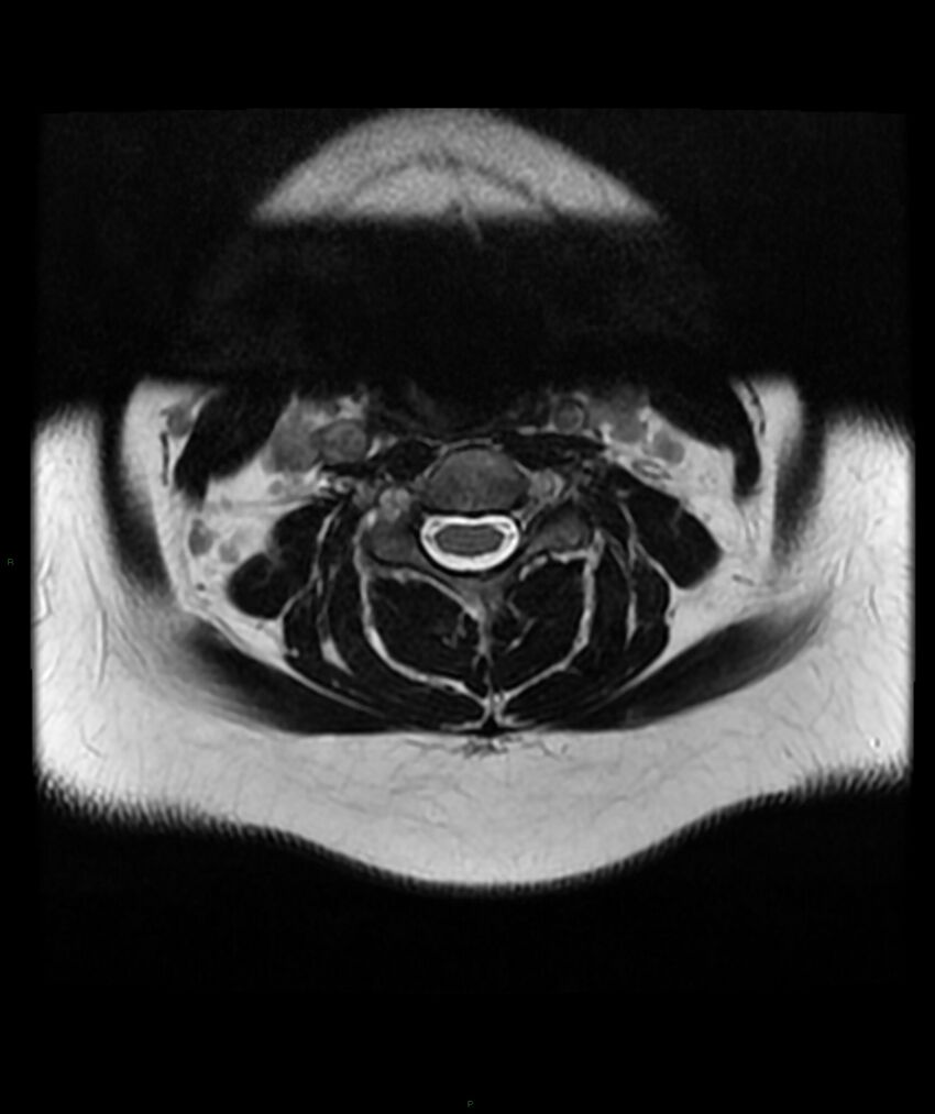 Cervical disc prolapse (Radiopaedia 80258-93598 Axial T2 18).jpg
