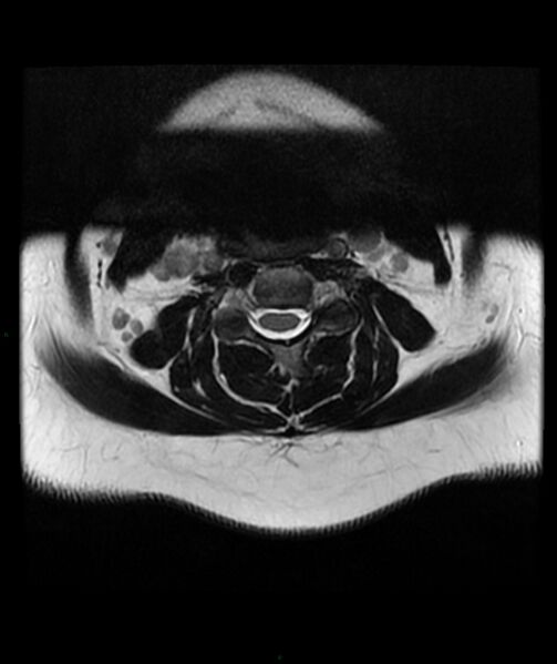 File:Cervical disc prolapse (Radiopaedia 80258-93598 Axial T2 22).jpg