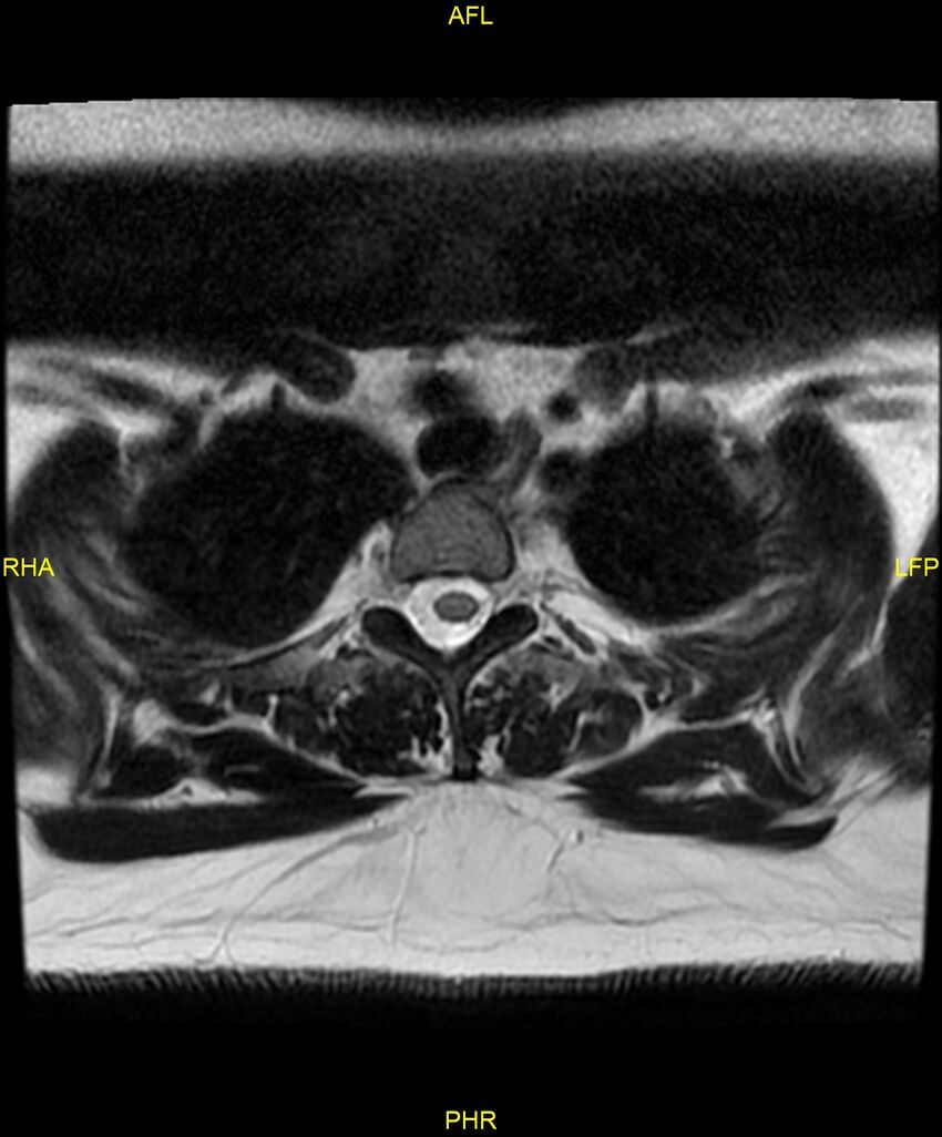 Cervical disc protrusion (Radiopaedia 87147-103415 Axial T2 95).jpg