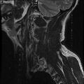 Cervical flexion teardrop fracture with cord hemorrhage (Radiopaedia 32497-33455 Sagittal T2 19).jpg