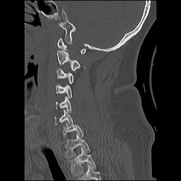 File:Cervical fracture and dislocation with locked facet (Radiopaedia 31837-32780 Sagittal bone window 10).jpg