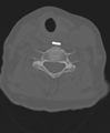 Cervical spine ACDF loosening (Radiopaedia 48998-54071 Axial bone window 38).png