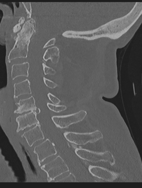 File:Cervical spondylolysis (Radiopaedia 49616-54811 Sagittal bone window 37).png