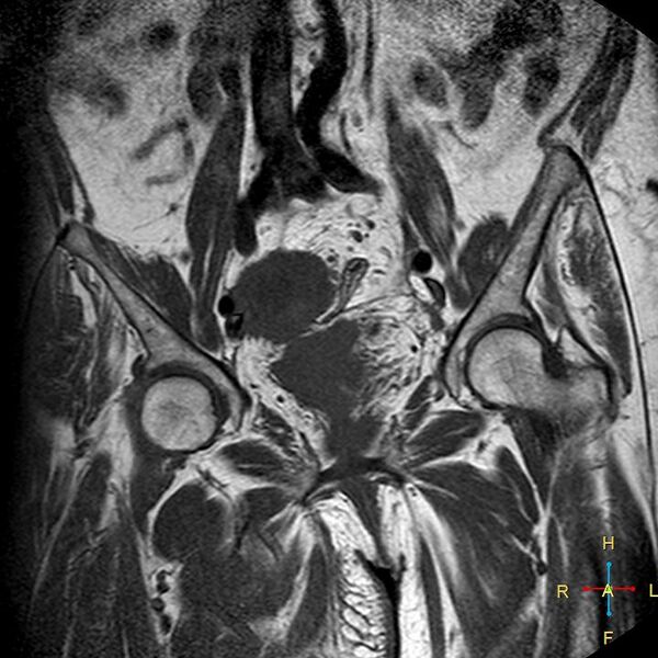 File:Cervical stump squamous cell carcinoma (Radiopaedia 48049-52858 Coronal T1 6).jpg