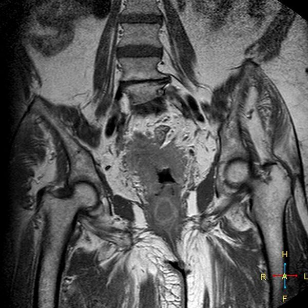 File:Cervical stump squamous cell carcinoma (Radiopaedia 48049-52858 Coronal T1 C+ 9).jpg