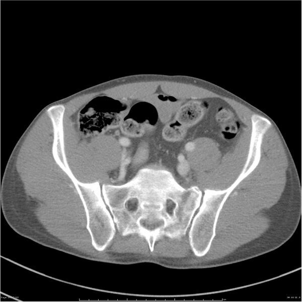 File:Chest and abdomen multi-trauma (Radiopaedia 26294-26426 A 66).jpg