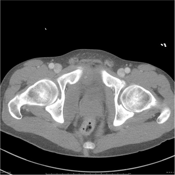 File:Chest and abdomen multi-trauma (Radiopaedia 26294-26426 A 86).jpg