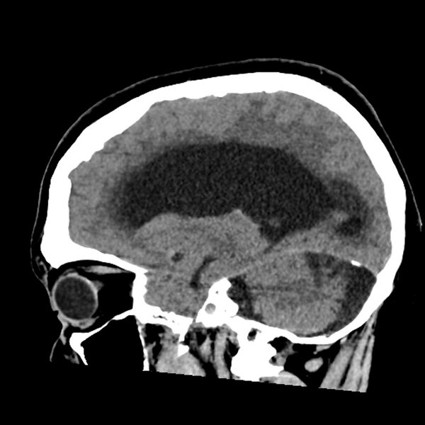 File:Chiasmatic-hypothalamic juvenile pilocytic astrocytoma (Radiopaedia 78533-91237 B 25).jpg