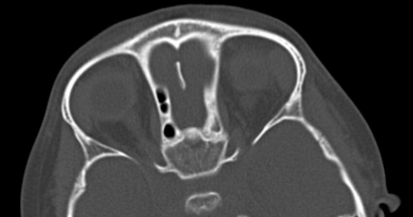 Choanal atresia (Radiopaedia 51295-56972 Axial bone window 54).jpg