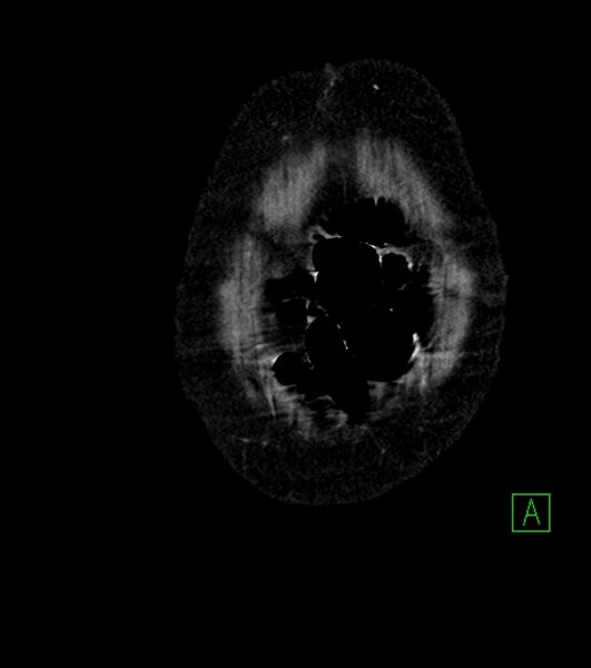 File:Cholangiocarcinoma with cerebral metastases (Radiopaedia 83519-98629 E 4).jpg