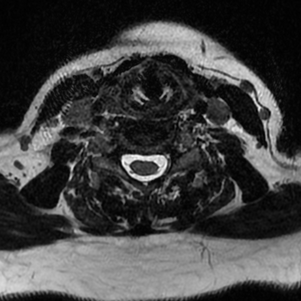 File:Chordoma - cervical spine (Radiopaedia 70084-80111 Axial T2 60).png