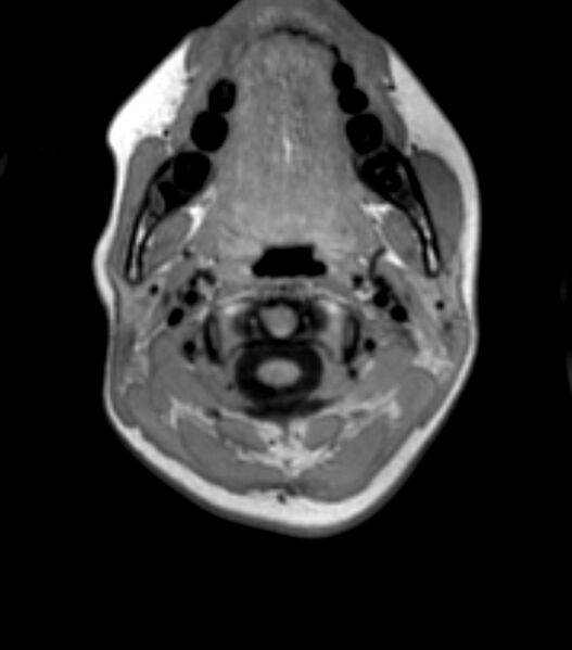 File:Choroid plexus carcinoma (Radiopaedia 91013-108553 Axial T1 7).jpg
