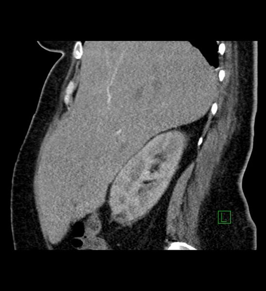 File:Chromophobe renal cell carcinoma (Radiopaedia 84239-99519 D 86).jpg