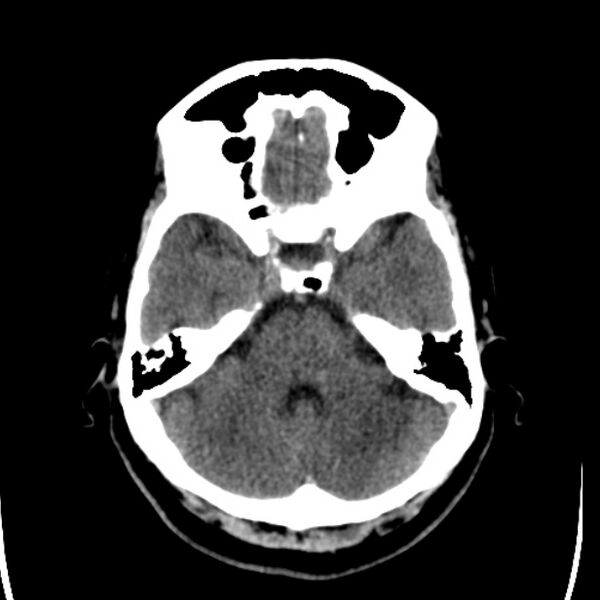 File:Chronic bilateral occipital lobe infarcts (Radiopaedia 31276-31996 Axial non-contrast 12).jpg