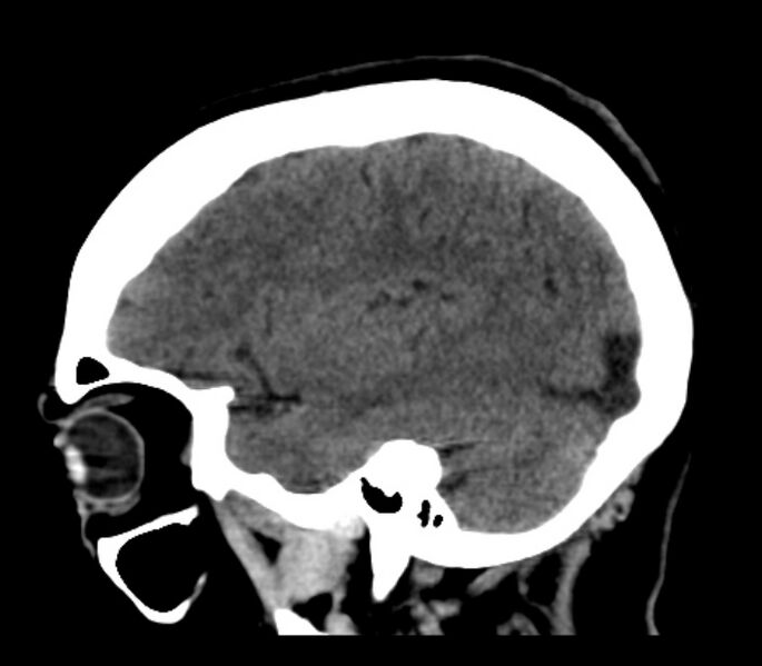 File:Chronic bilateral occipital lobe infarcts (Radiopaedia 31276-31996 C 12).jpg