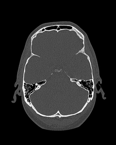File:Chronic maxillary sinusitis caused by a foreign body (Radiopaedia 58521-65676 Axial bone window 276).jpg