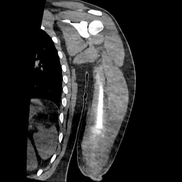 File:Chronic osteomyelitis (Radiopaedia 67597-76998 Coronal Soft tissue 15).jpg