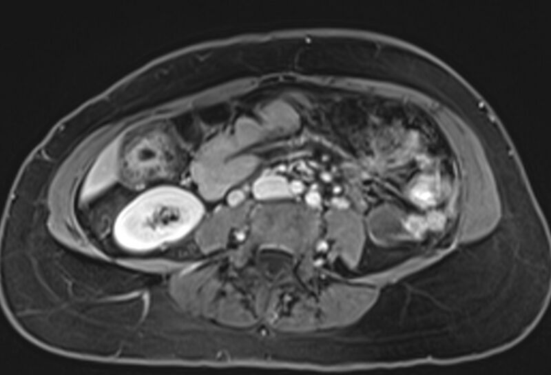 File:Chronic pancreatitis - pancreatic duct calculi (Radiopaedia 71818-82250 Axial T1 C+ fat sat 50).jpg
