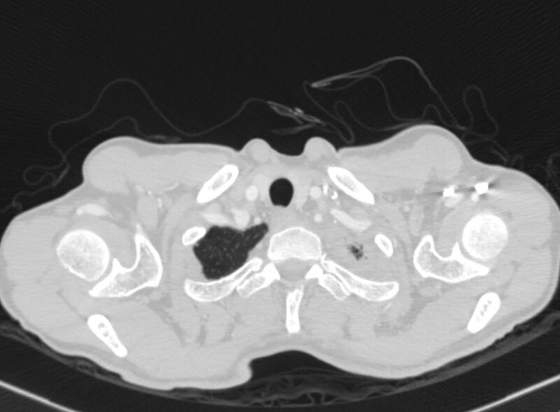 File:Chronic pulmonary embolism with bubbly consolidation (Radiopaedia 91248-108850 Axial lung window 1).jpg