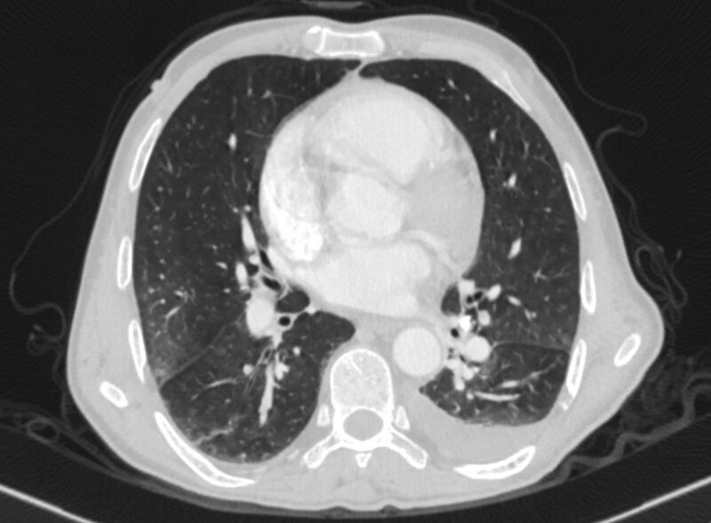 File:Chronic pulmonary embolism with bubbly consolidation (Radiopaedia 91248-108850 Axial lung window 91).jpg