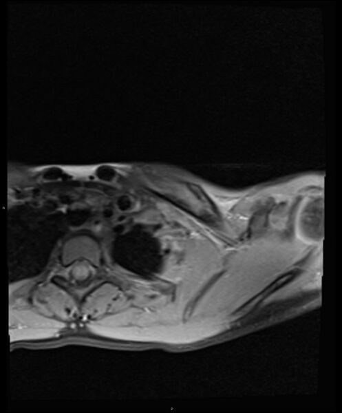 File:Chronic reactive multifocal osteomyelitis (CRMO) - clavicle (Radiopaedia 56406-63114 Axial T1 fat sat 10).jpg
