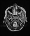 Chronic reactive multifocal osteomyelitis (CRMO) - mandible (Radiopaedia 56405-63069 Axial T2 18).jpg