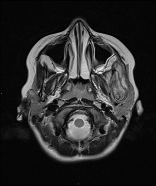 File:Chronic reactive multifocal osteomyelitis (CRMO) - mandible (Radiopaedia 56405-63069 Axial T2 18).jpg