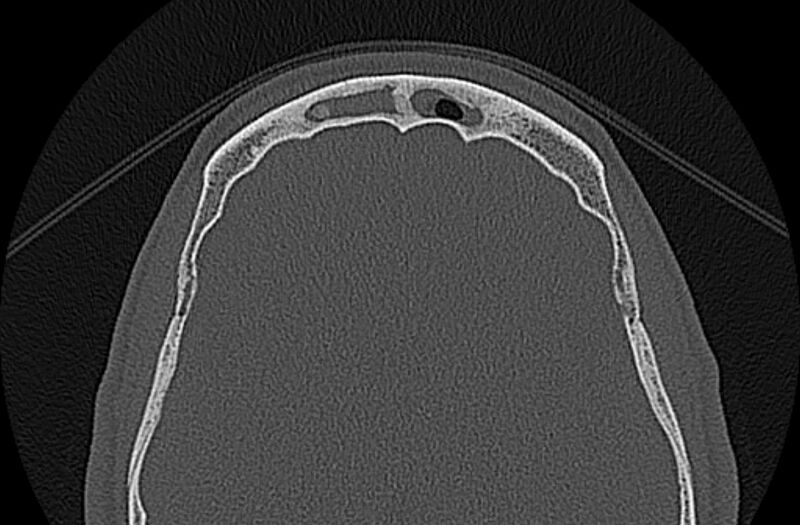 File:Chronic rhinosinusitis (Radiopaedia 65079-74075 Axial bone window 79).jpg