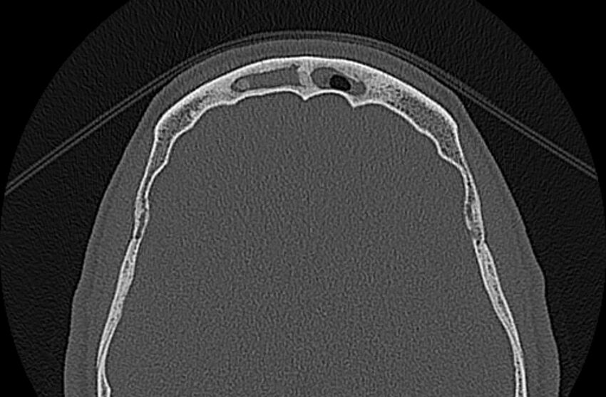 Chronic rhinosinusitis (Radiopaedia 65079-74075 Axial bone window 79).jpg