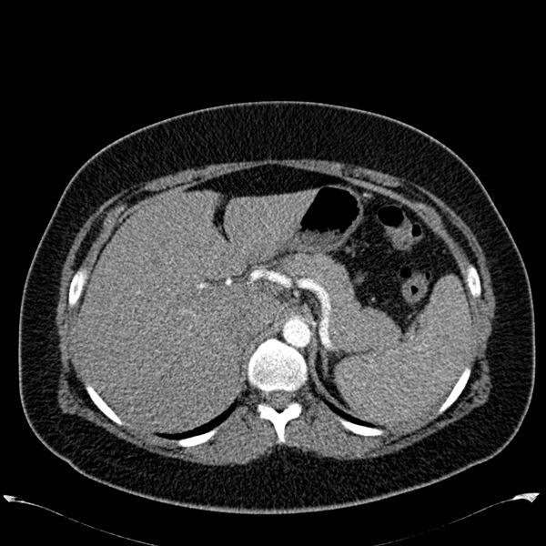 File:Chronic thromboembolic pulmonary hypertension (CTEPH) (Radiopaedia 74597-85531 Axial C+ CTPA 55).jpg