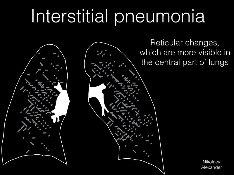 File:Classification of pneumonia (Radiopaedia 53288-59258 C 1).jpeg