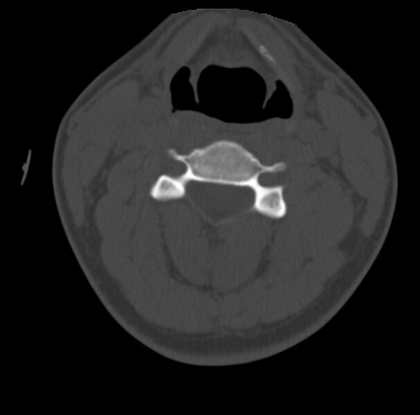 File:Clay-shoveler fracture (Radiopaedia 22568-22590 Axial bone window 33).jpg