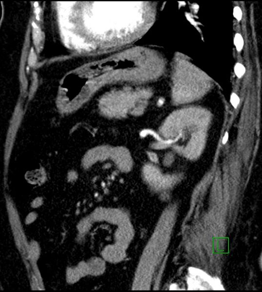 File:Clear cell renal cell carcinoma (Radiopaedia 85004-100537 D 22).jpg