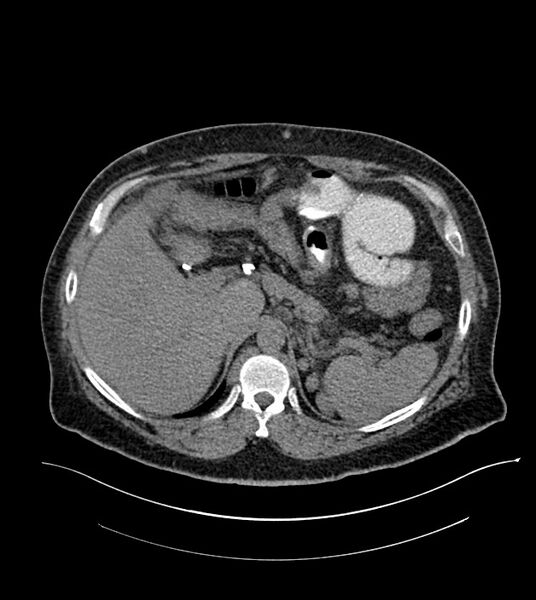 File:Closed-loop small bowel obstruction-internal hernia (Radiopaedia 78439-91096 Axial non-contrast 38).jpg