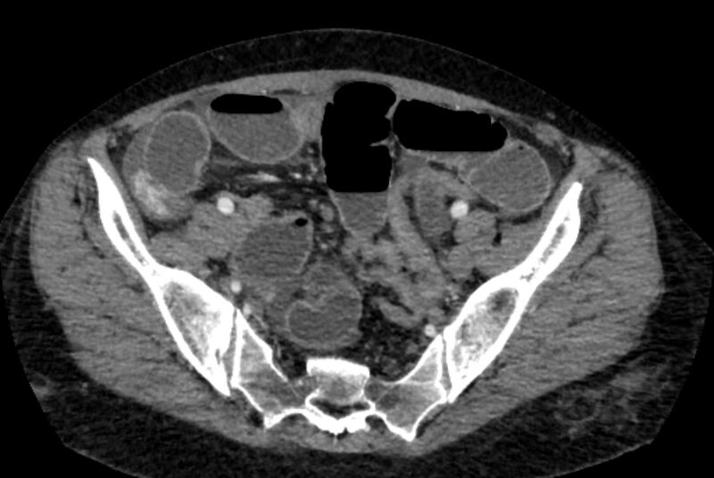 File:Closed loop small bowel obstruction (Radiopaedia 71211-81508 A 124).jpg