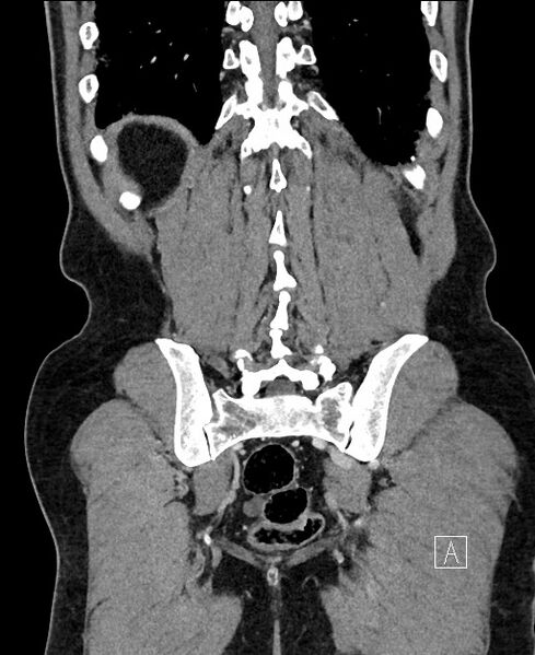 File:Closed loop small bowel obstruction - internal hernia (Radiopaedia 57806-64778 A 99).jpg