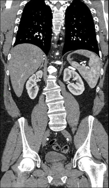 File:Coarctation of the aorta (Radiopaedia 74632-88521 B 155).jpg