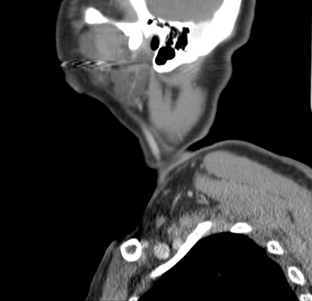 File:Colloid cyst of thyroid (Radiopaedia 22897-22923 Sagittal C+ delayed 51).jpg