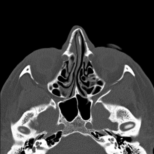 File:Nasal septal perforation (Radiopaedia 25030-25289 Axial bone window 30).jpg