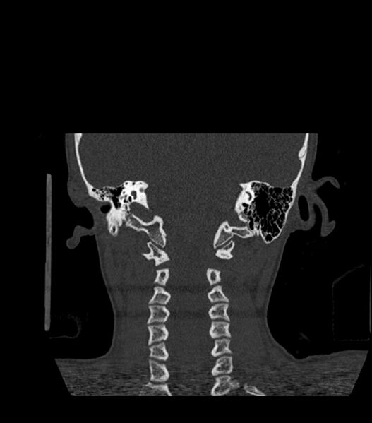 File:Nasoorbitoethmoid fracture (Radiopaedia 90044-107205 Coronal bone window 111).jpg