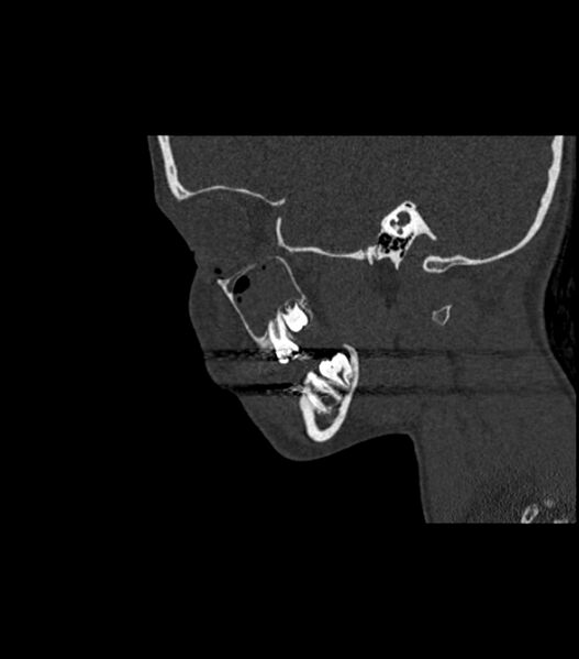 File:Nasoorbitoethmoid fracture (Radiopaedia 90044-107205 Sagittal bone window 101).jpg