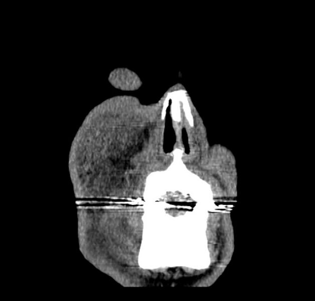 File:Necrobiotic xanthogranuloma- face (Radiopaedia 29549-30052 A 1).jpg