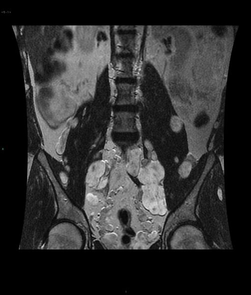 File:Neurofibromatosis type 1 (Radiopaedia 36933-38560 Coronal T2 1).jpg