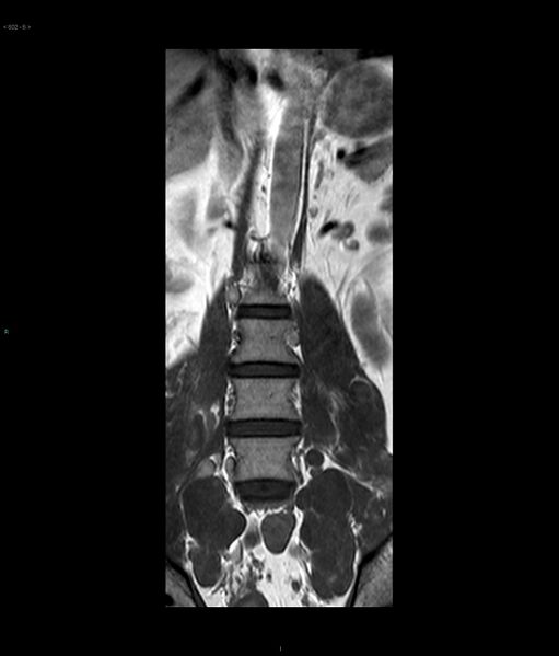 File:Neurofibromatosis type 1 (Radiopaedia 36933-38560 E 6).jpg