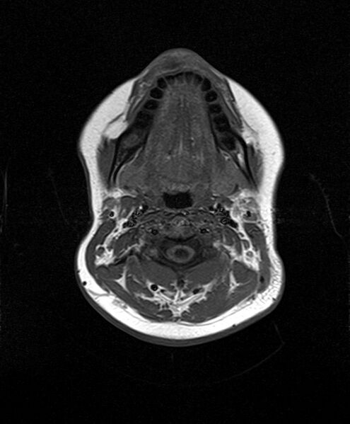 File:Neurofibromatosis type 2 (Radiopaedia 66211-75401 Axial T1 2).jpg