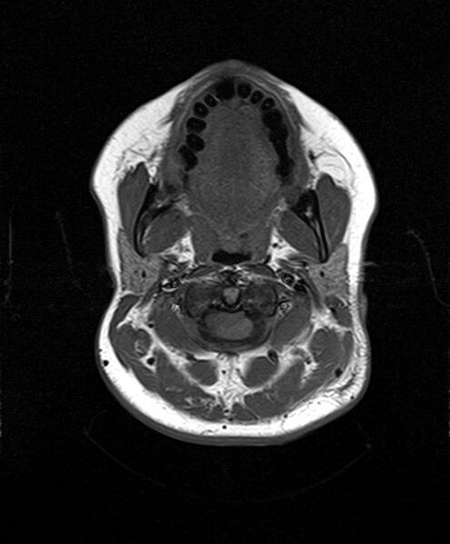 File:Neurofibromatosis type 2 (Radiopaedia 66211-75401 Axial T1 4).jpg