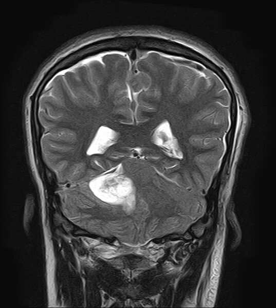 File:Neurofibromatosis type 2 (Radiopaedia 66211-75401 Coronal T2 17).jpg