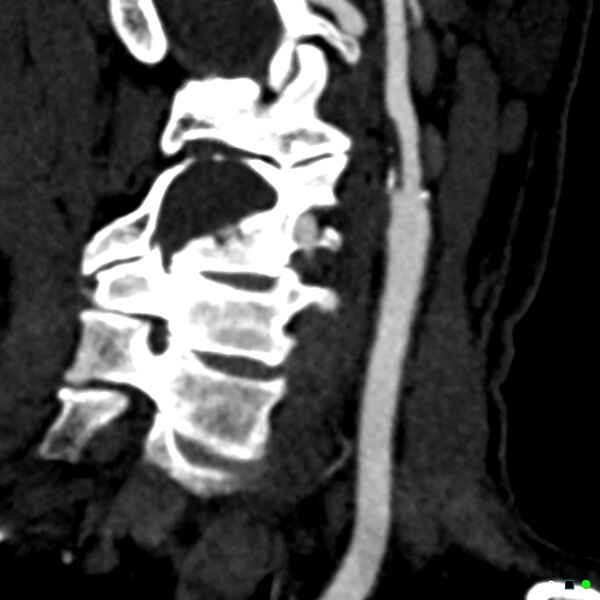 File:Non-occlusive intraluminal internal carotid artery thrombus (Radiopaedia 37751-39658 C 5).jpg