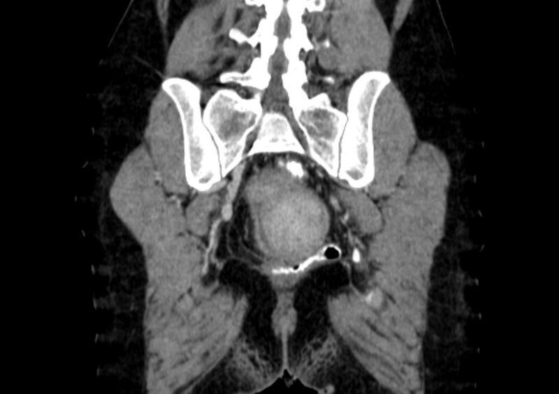 File:Non-puerperal uterine inversion (Radiopaedia 78343-91094 B 51).jpg